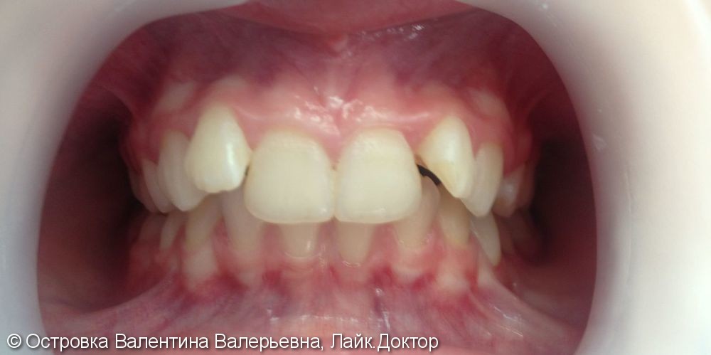 Скученное положение зубов на верхней и нижней челюстях - фото №1