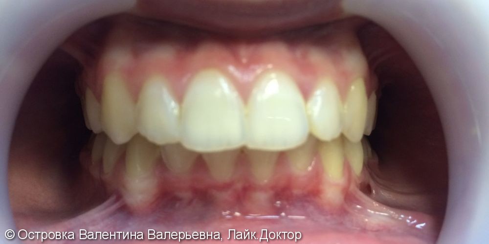 Скученное положение зубов на верхней и нижней челюстях - фото №2