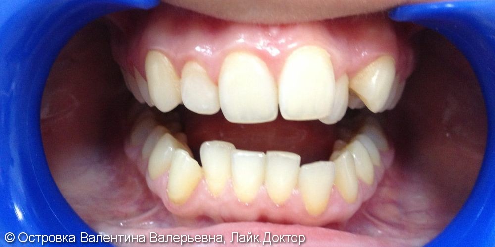 Ортодонтическое лечение зубов самолигирующей брекет-системой Damon Q - фото №1