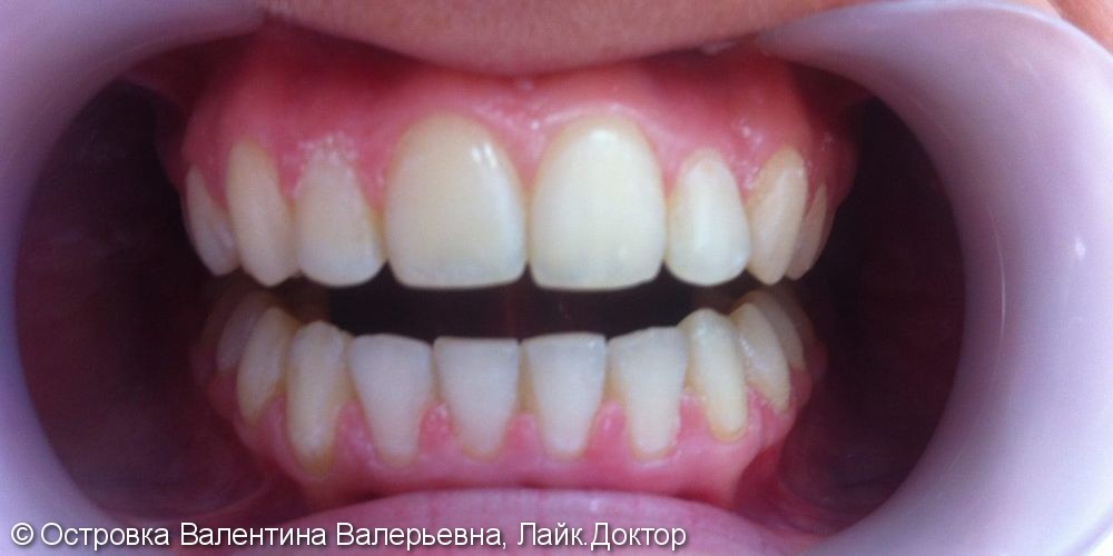 Ортодонтическое лечение зубов самолигирующей брекет-системой Damon Q - фото №2