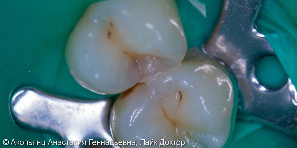 Лечение скрытого кариеса между зубов, до и после - фото №1