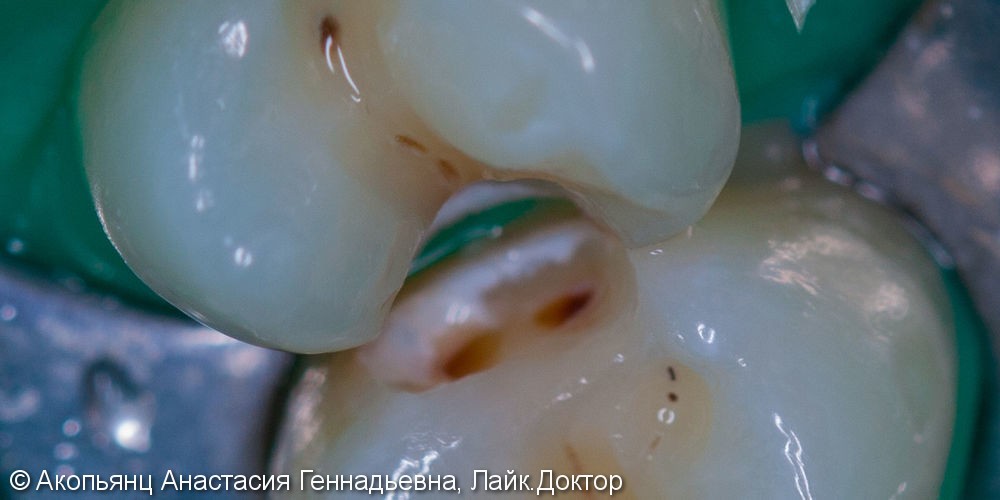 Лечение скрытого кариеса между зубов, до и после - фото №2
