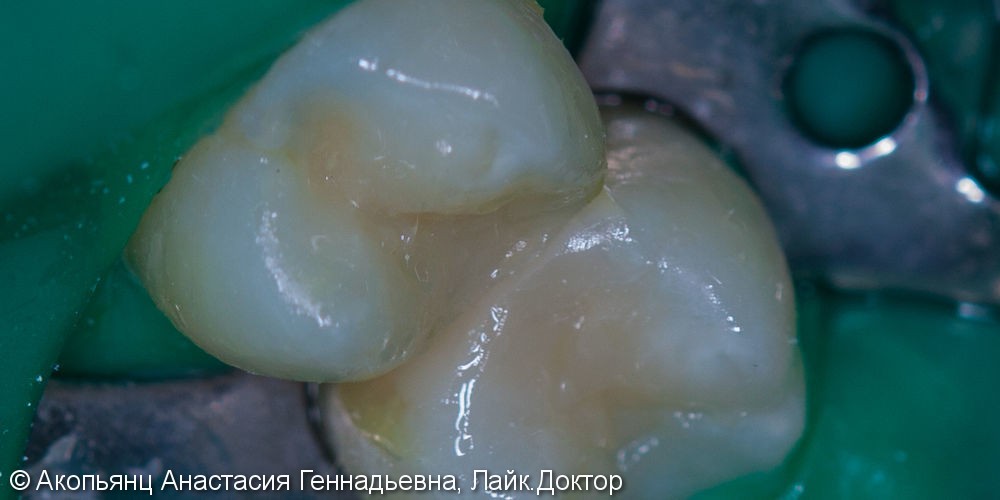 Лечение скрытого кариеса между зубов, до и после - фото №3