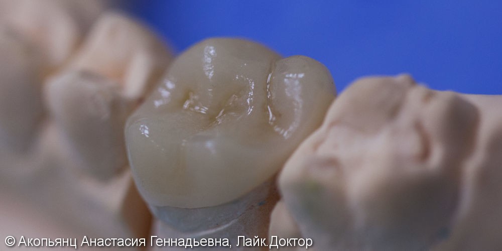 Восстановление 1.6 зуба вкладкой E.max - фото №4