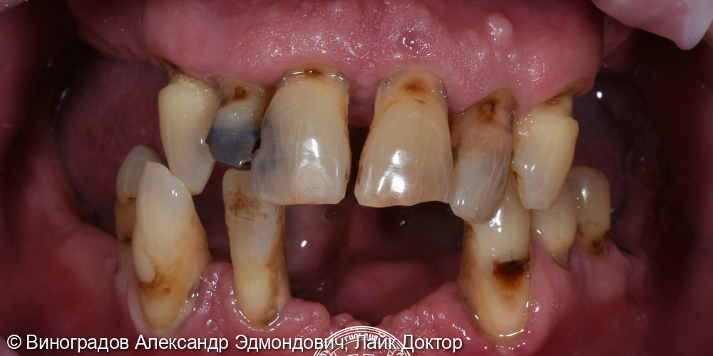 Удаление зубов и установка 10 имплантатов Astra Tech с последующей фиксацией адаптационных протезов - фото №1