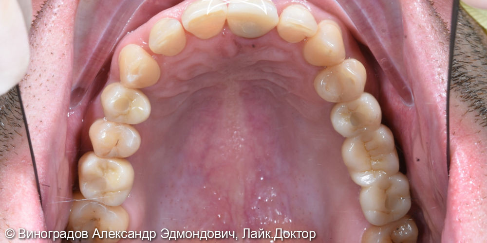 эстетическо - фунциональное восстановление зубных рядов - фото №2