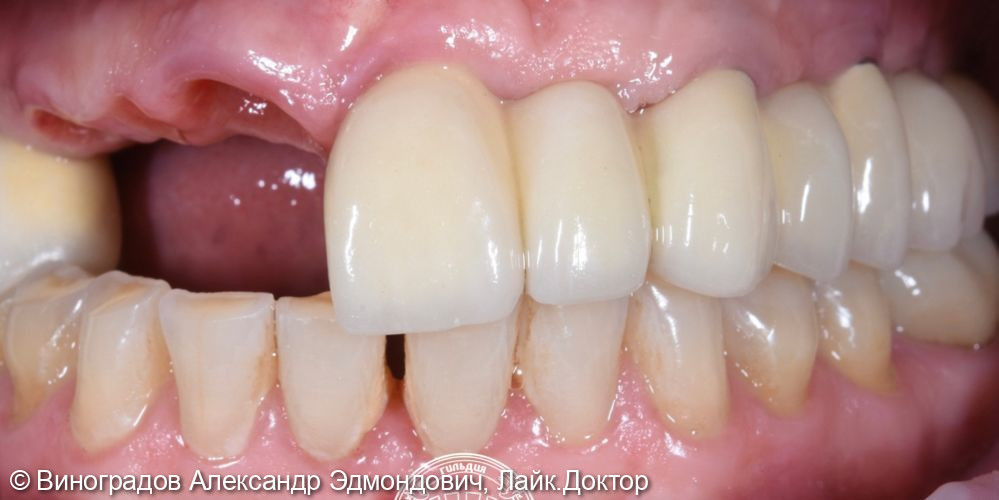 Восстановление отсутствующих зубов выполнено имплантантами ASTRA и металлокерамическими коронками - фото №1