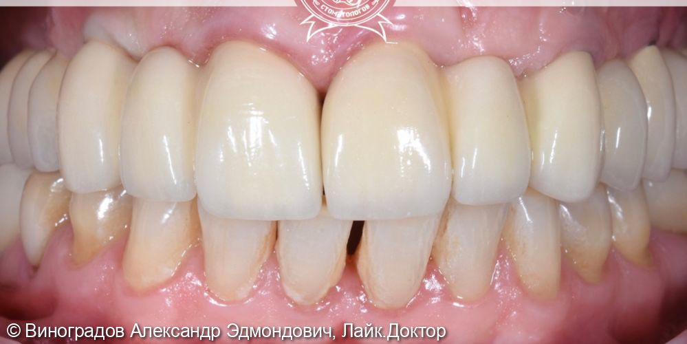 Восстановление отсутствующих зубов выполнено имплантантами ASTRA и металлокерамическими коронками - фото №2