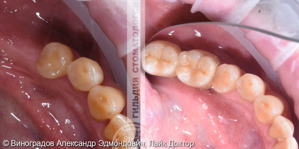 Замещение отсутствующих зубов при помощи имплантатов фирмы Astra Tech (Швеция), коронки были сделаны на основе диоксида циркония - фото №1