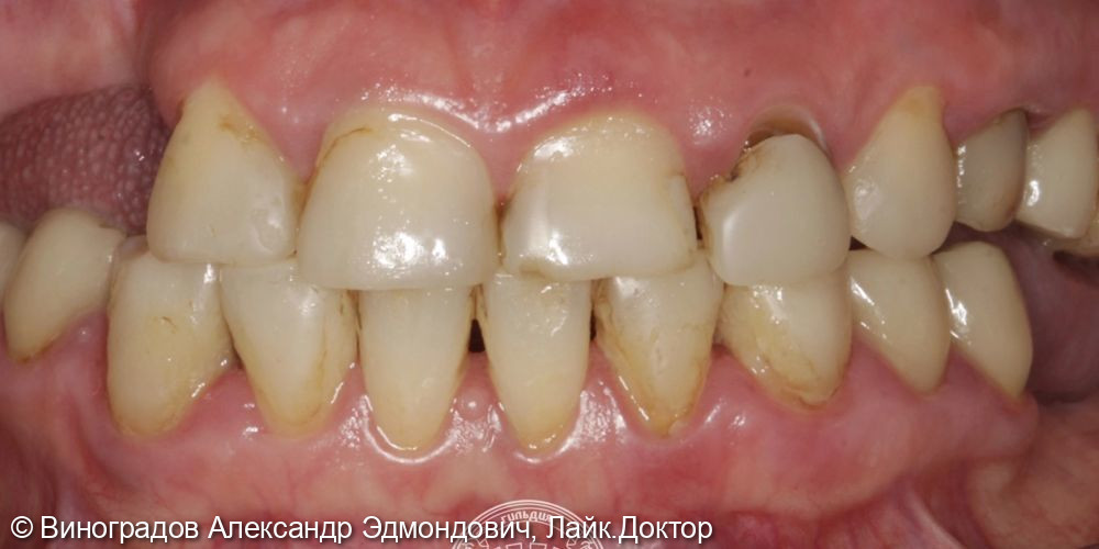 Пациент обратился в клинику с жалобами на отсутствующие зубы и эстетическое несовершенство - фото №1