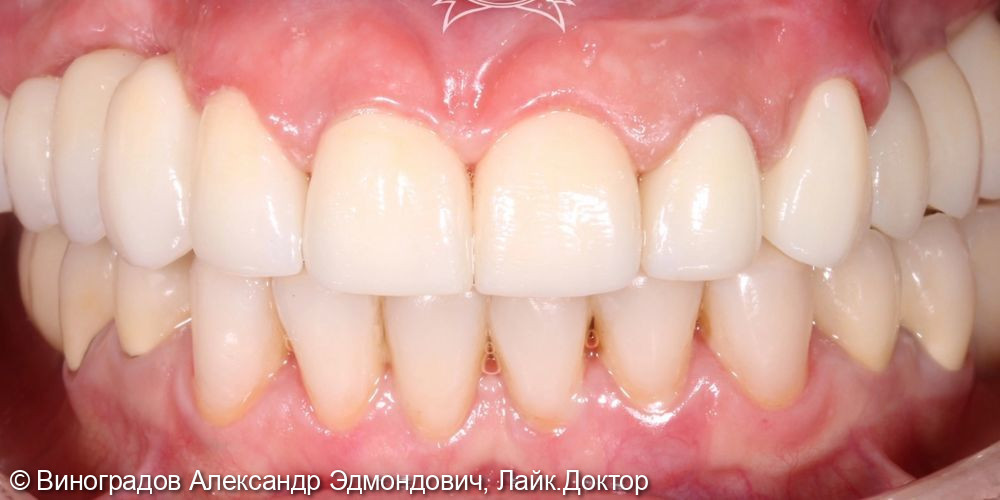 Пациент обратился в клинику с жалобами на отсутствующие зубы и эстетическое несовершенство - фото №2