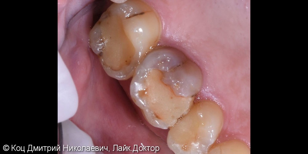 Керамическая непрямая реставрация Emax на зубы 15, 16, 17 - фото №1