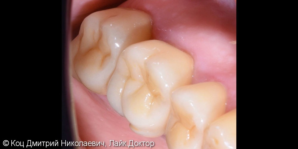 Керамическая непрямая реставрация Emax на зубы 15, 16, 17 - фото №2