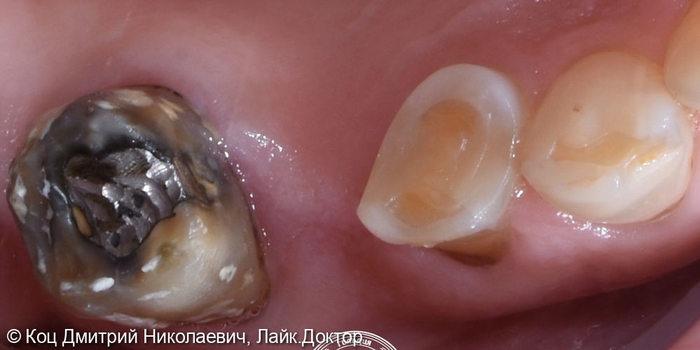 Пример клинического случая изготовления керамической непрямой реставрации e. Max на зубы 16, 14 - фото №1