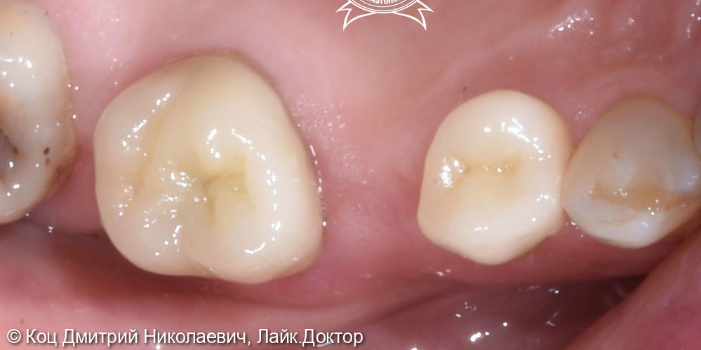 Пример клинического случая изготовления керамической непрямой реставрации e. Max на зубы 16, 14 - фото №2