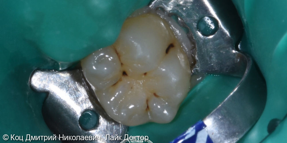 Эстетическое восстановление 37 зуба, лечение кариеса (1-2поверхности) - фото №1