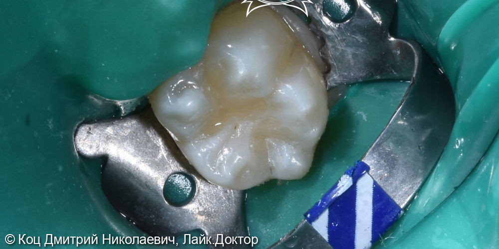 Эстетическое восстановление 37 зуба, лечение кариеса (1-2поверхности) - фото №2