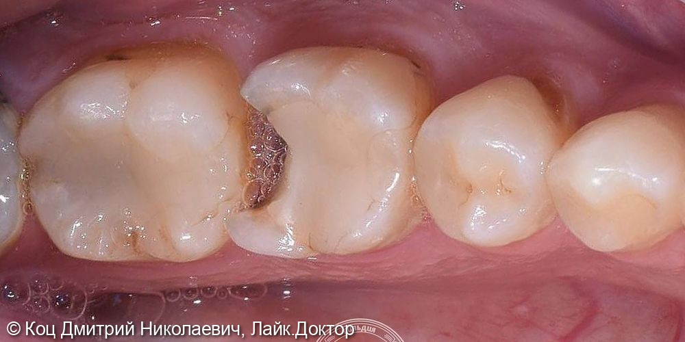 Восстановление зуба, у которого дентин и эмаль разрушены на 50% и более - фото №1
