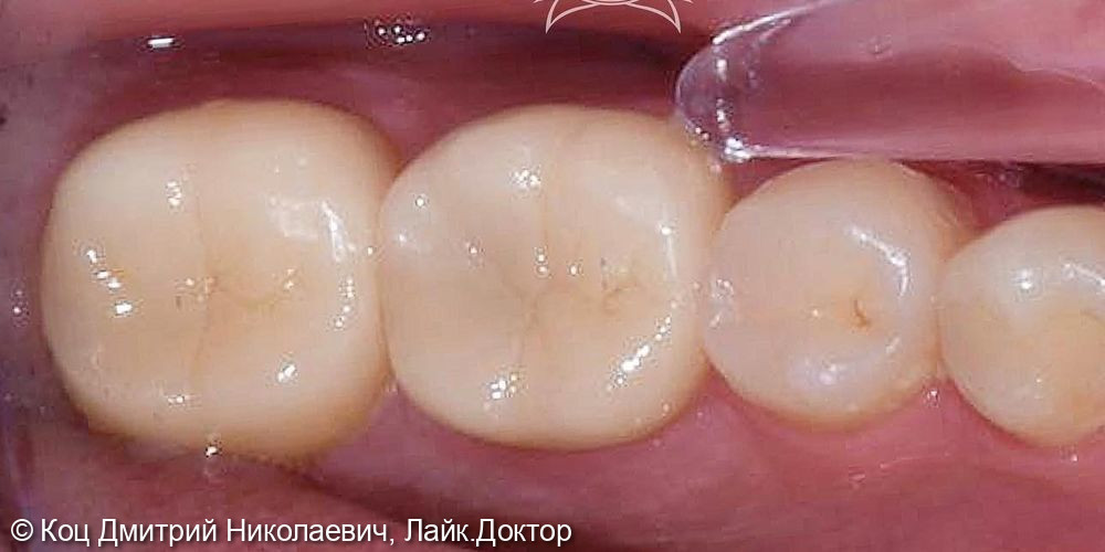 Восстановление зуба, у которого дентин и эмаль разрушены на 50% и более - фото №2