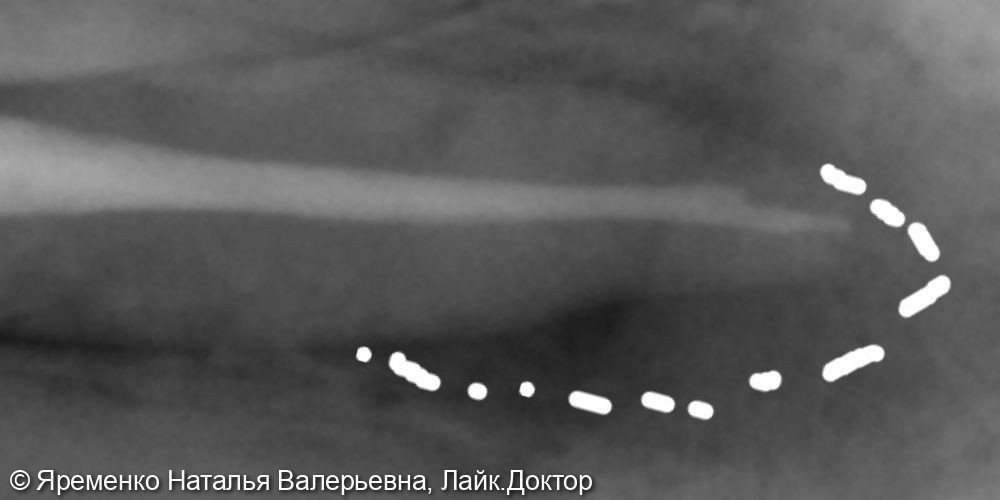 Эндодонтическое лечение- воспаление верхушки корня - фото №1