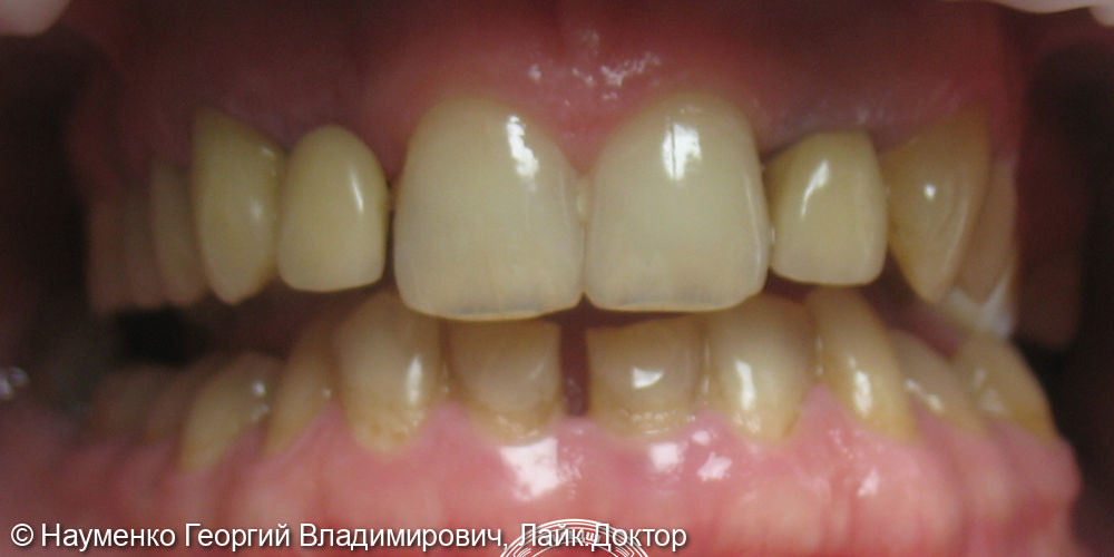 Клинический случай комплексного восстановления зубов - фото №1