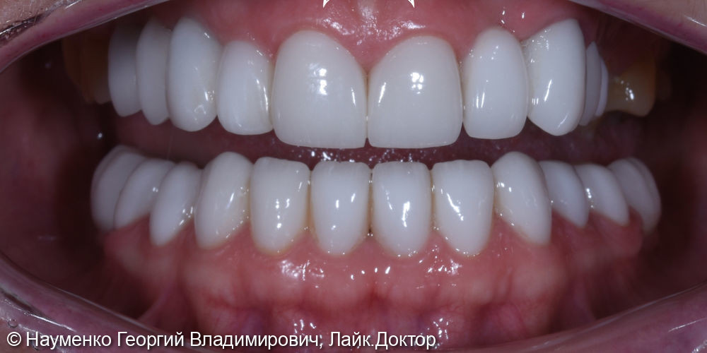 Клинический случай комплексного восстановления зубов - фото №2