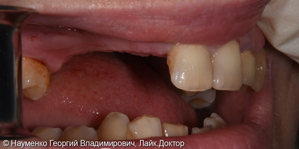 Клинический случай комплексного восстановления зубов - фото №3