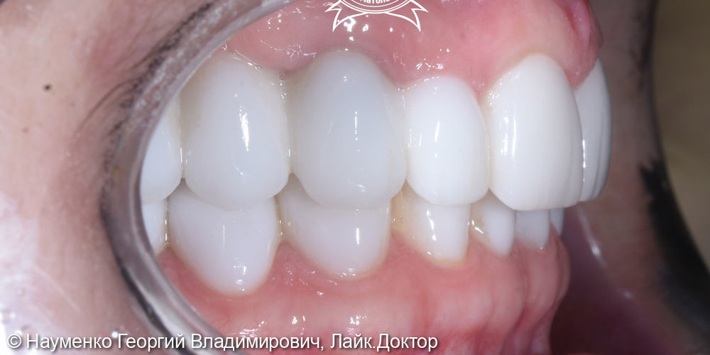 Клинический случай комплексного восстановления зубов - фото №4