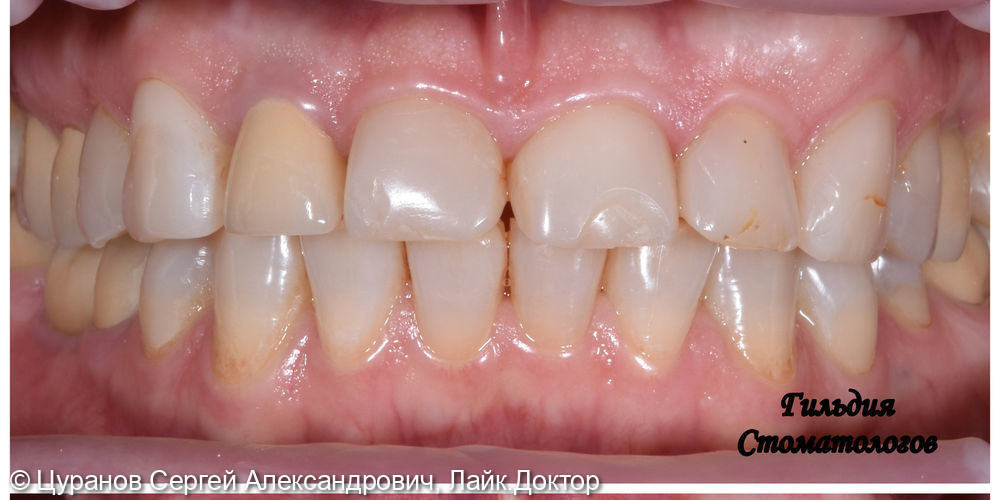 Эстетическое восстановление фронтальной группы зубов верхней челюсти винирами e.Max - фото №1