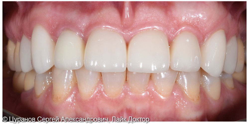 Эстетическое восстановление фронтальной группы зубов верхней челюсти винирами e.Max - фото №2