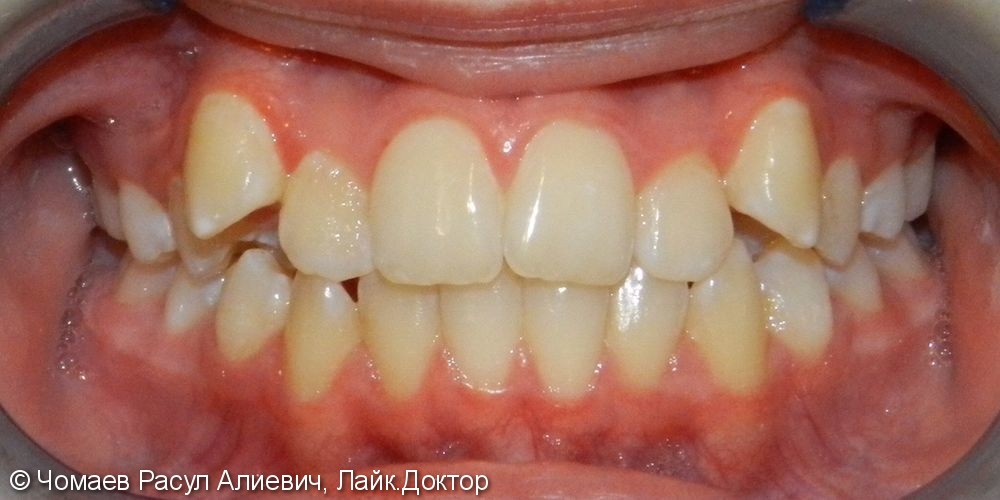 Результат ортодонтического лечения - фото №1