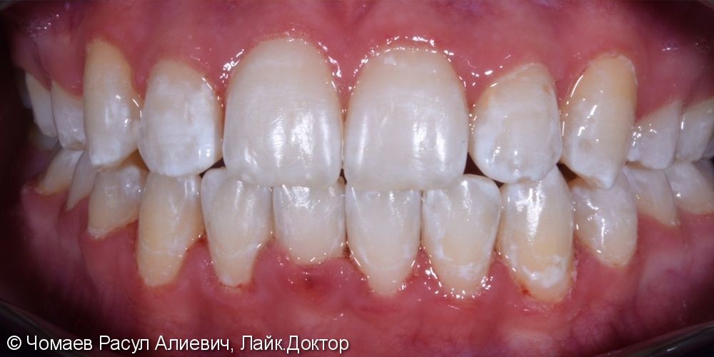 Результат ортодонтического лечения - фото №2