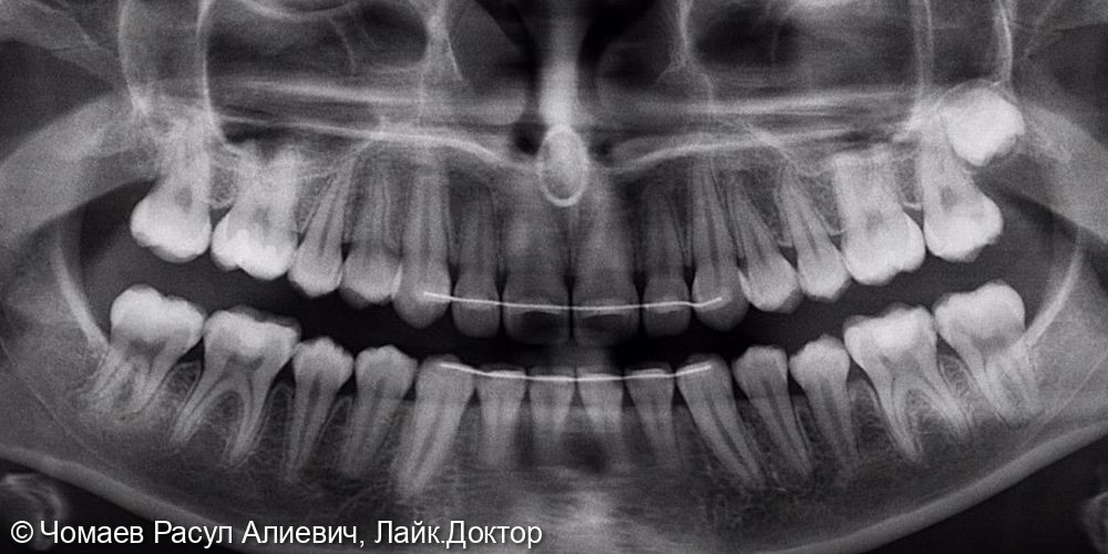 Лечение глубокого дистального прикуса - фото №2