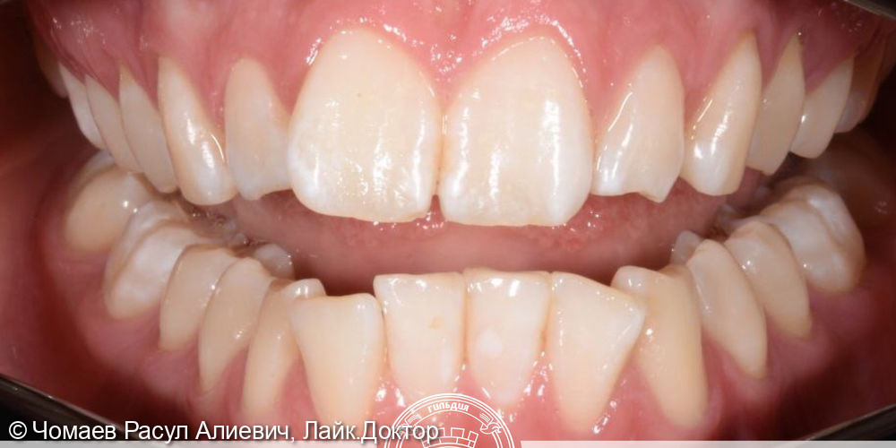 Ортодонтическое лечение исправления патологического прикуса системой элайнеров Flexiligner - фото №1
