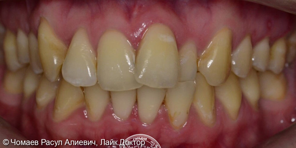 Ортодонтическое лечение брекет- системой Damon Q - фото №1