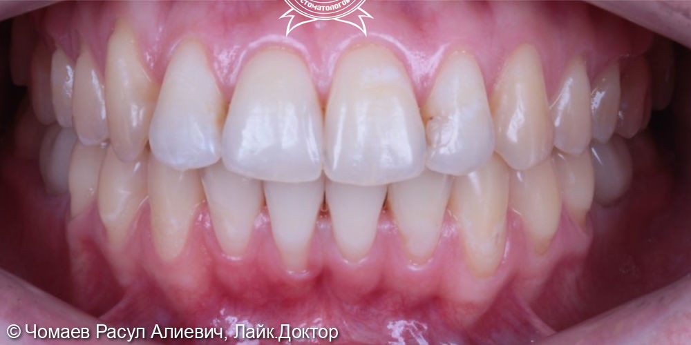 Ортодонтическое лечение брекет- системой Damon Q - фото №2