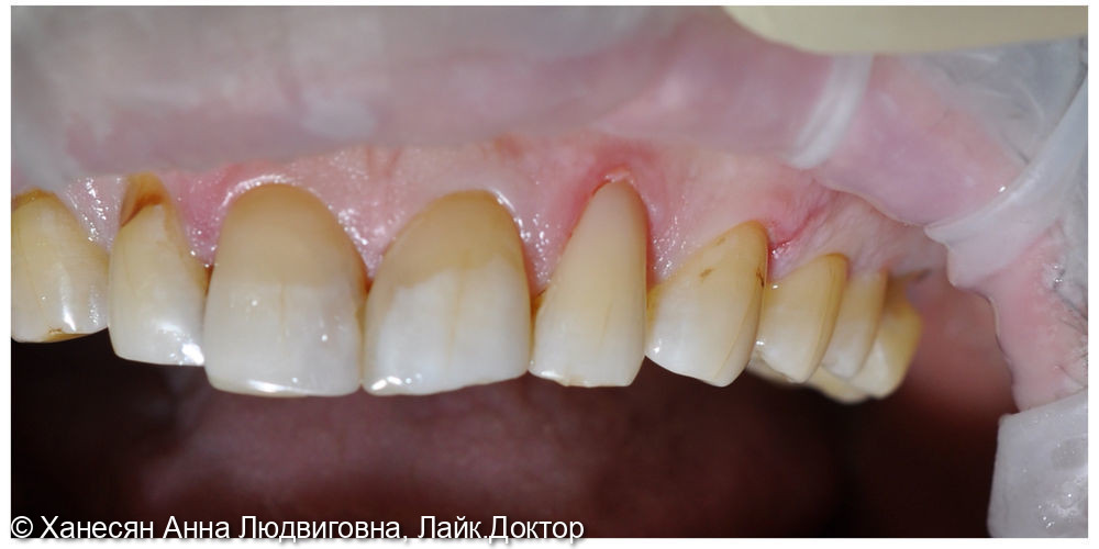 Клинический пример лечения пришеечной кариозной полости зуба 22 - фото №2