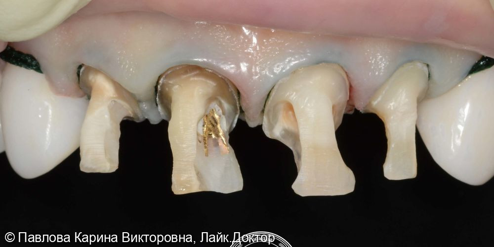 Композитная прямая реставрация передних четырёх зубов в одно посещение композиционным материалом премиум уровня - фото №1