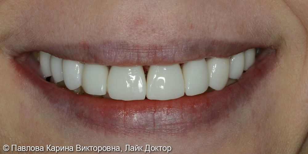 Композитная прямая реставрация передних четырёх зубов в одно посещение композиционным материалом премиум уровня - фото №2