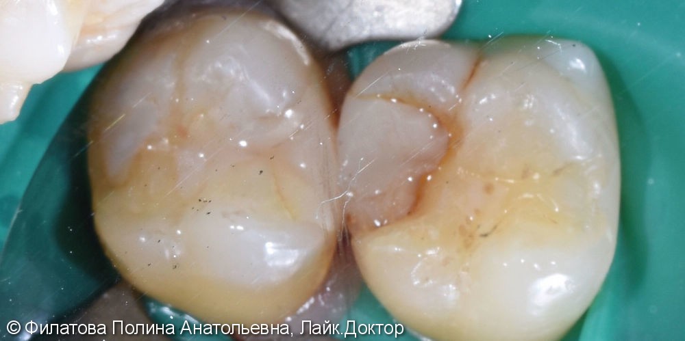 Клинический пример лечения кариеса зубов 16 и 17 - фото №1