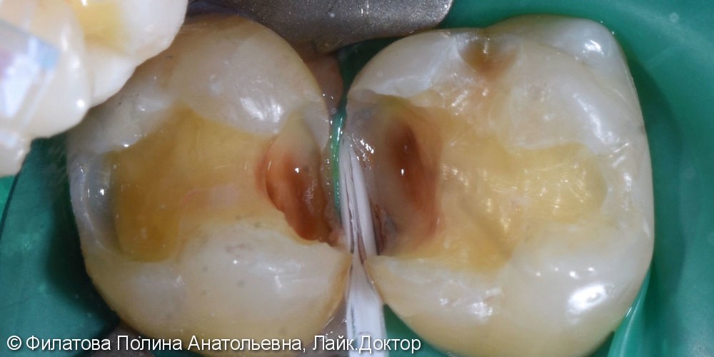 Клинический пример лечения кариеса зубов 16 и 17 - фото №2