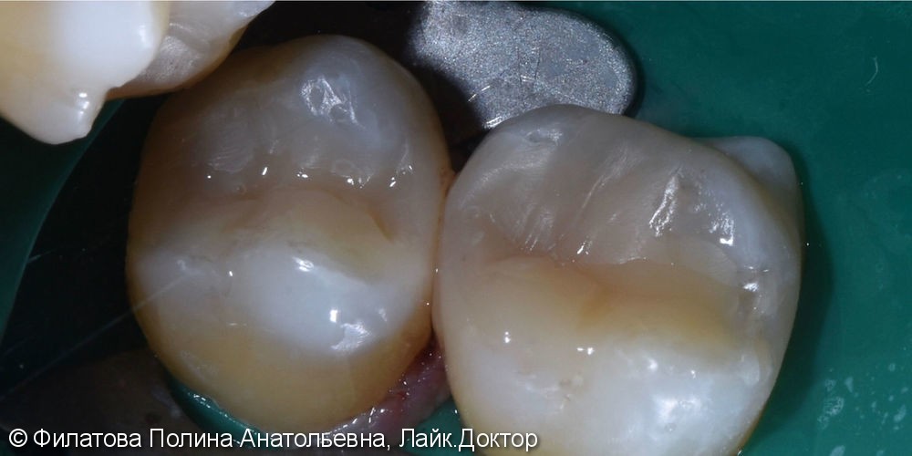 Клинический пример лечения кариеса зубов 16 и 17 - фото №3