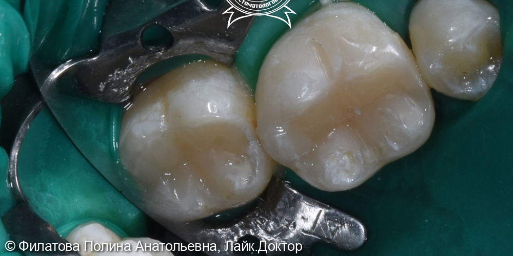 Лечение кариеса зубов 46, 47 - фото №2