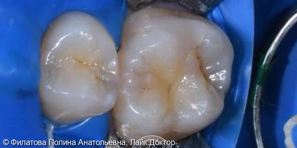 В клинику обратился пациент с жалобой на наличие кариозных полостей в области 25 и 26 зубов - фото №1