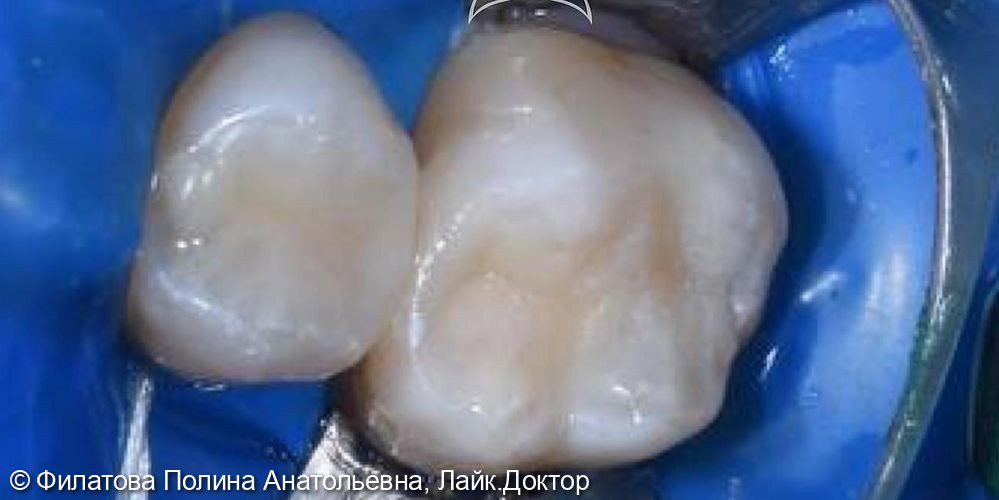 В клинику обратился пациент с жалобой на наличие кариозных полостей в области 25 и 26 зубов - фото №2