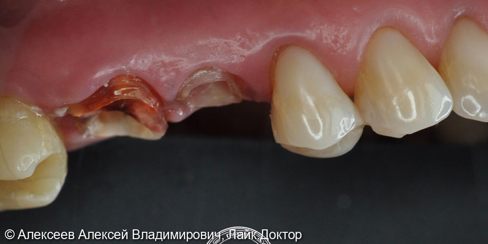 Восстановление коронковой части зуба - фото №1