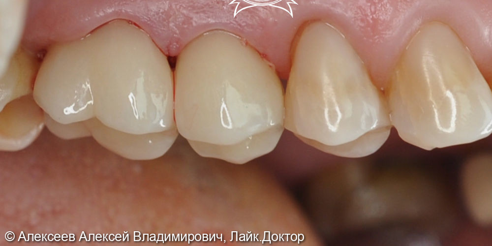 Восстановление коронковой части зуба - фото №2
