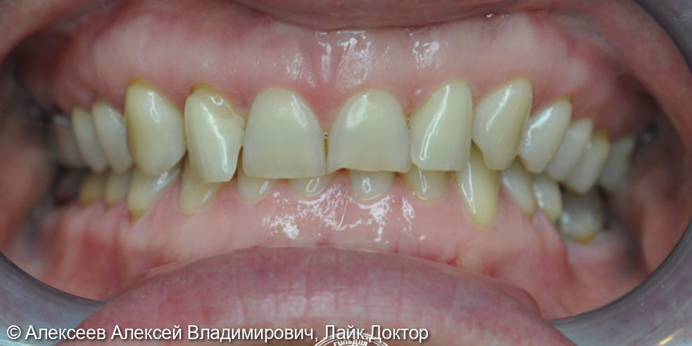 Эстетическо - фунциональное восстановление зубных рядов - фото №1