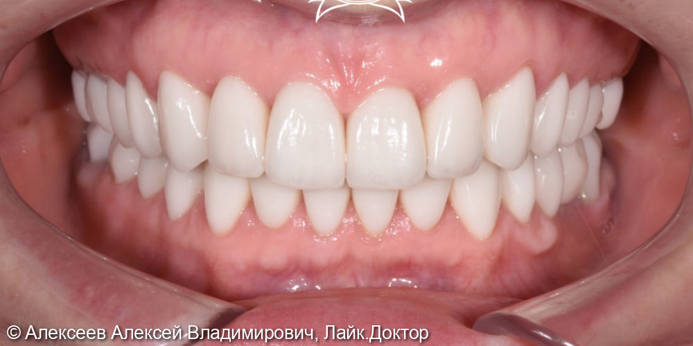 Эстетическо - фунциональное восстановление зубных рядов - фото №2