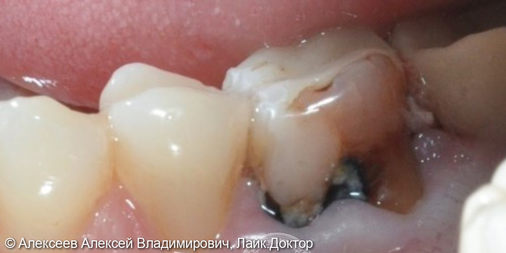Удаление зуба с одновременной имплантацией и пластикой мягких тканей.  - фото №1